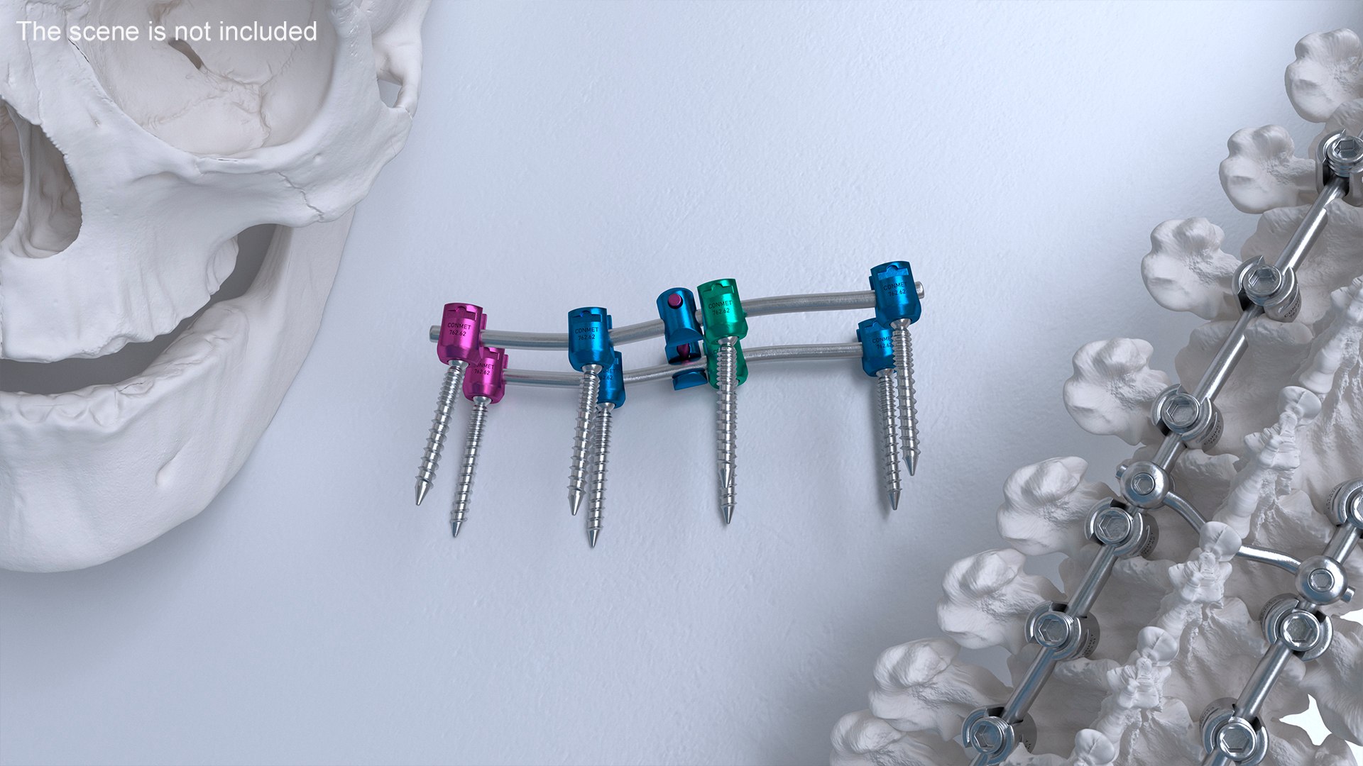 Lumbar Cervical Spine Fixation System Colored 3D model https://p.turbosquid.com/ts-thumb/M2/GZ5x1O/mM/lumbarcervicalspinefixationsystemcoloredvray3dmodel004/jpg/1710685355/1920x1080/fit_q87/027330763cf206dd8e2bd87d5574d8e2f23f119f/lumbarcervicalspinefixationsystemcoloredvray3dmodel004.jpg