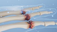 3D Animation for Repair of Hand Gout Arthritis