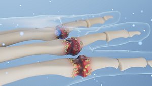 3D Animation for Repair of Hand Gout Arthritis