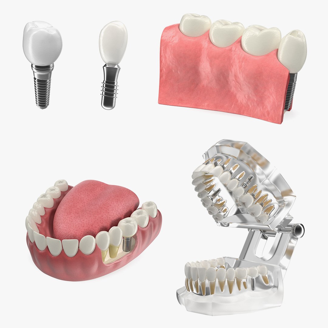 Tooth Implants Collection 3D model preview