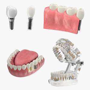 Tooth Implants Collection
