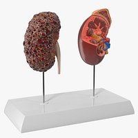 Kidney Comparison Model Healthy and Polycystic