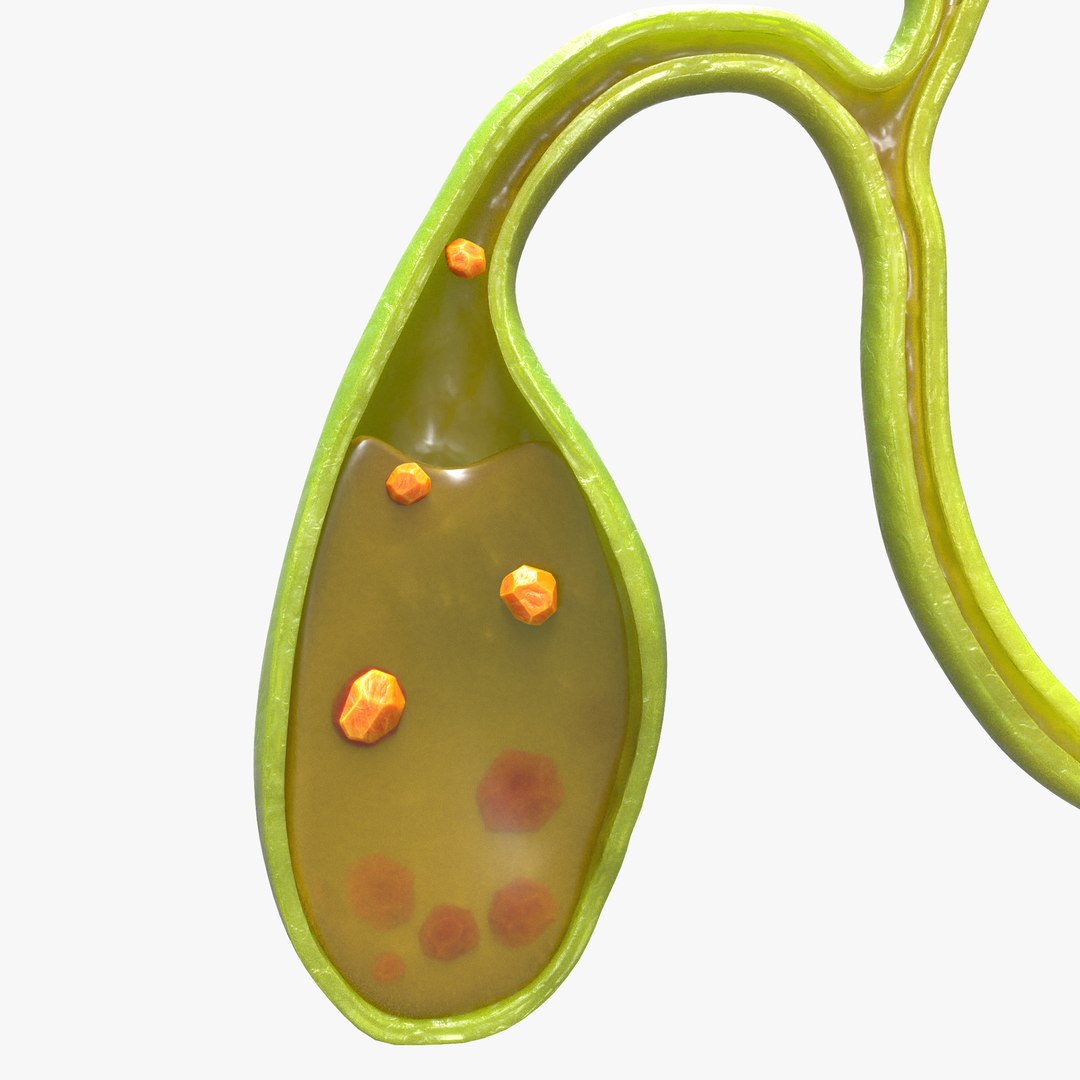 Gallbladder With Gallstones Model - TurboSquid 1842451