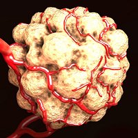 Tumor with Vessels