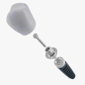 Dental tooth implant