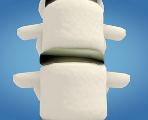 3D spine compression