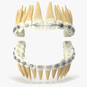 Human Teeth With Self Ligating Steel Dental Braces V02 model