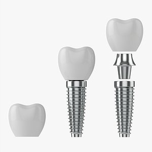 3D Tooth implant