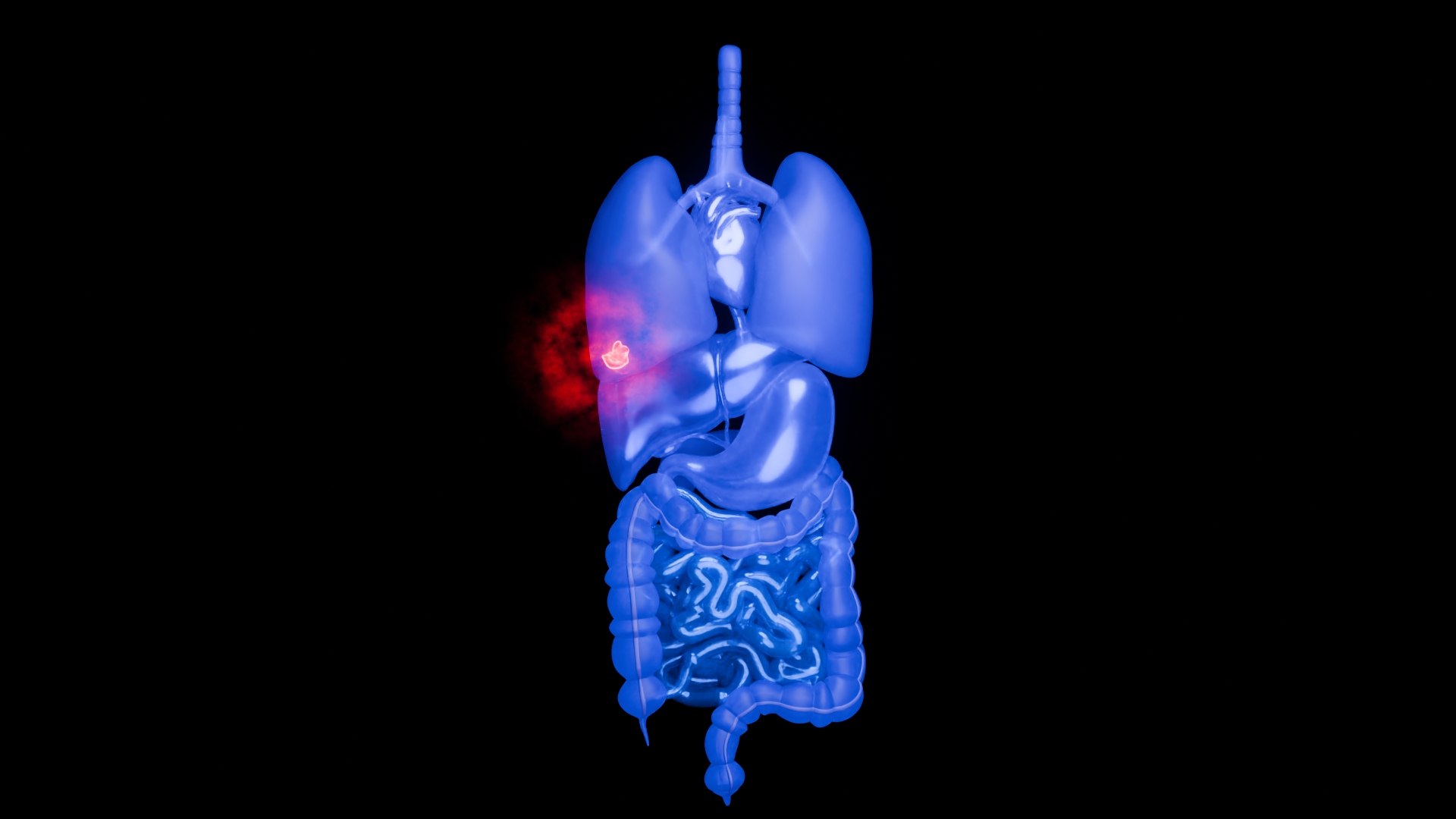 3D Organ with Cancer https://p.turbosquid.com/ts-thumb/Nv/xzPm2l/Tw/0051/jpg/1773569944/1920x1080/fit_q87/b3f88c5f953250b6fb7ad10516a3108117fffc26/0051.jpg