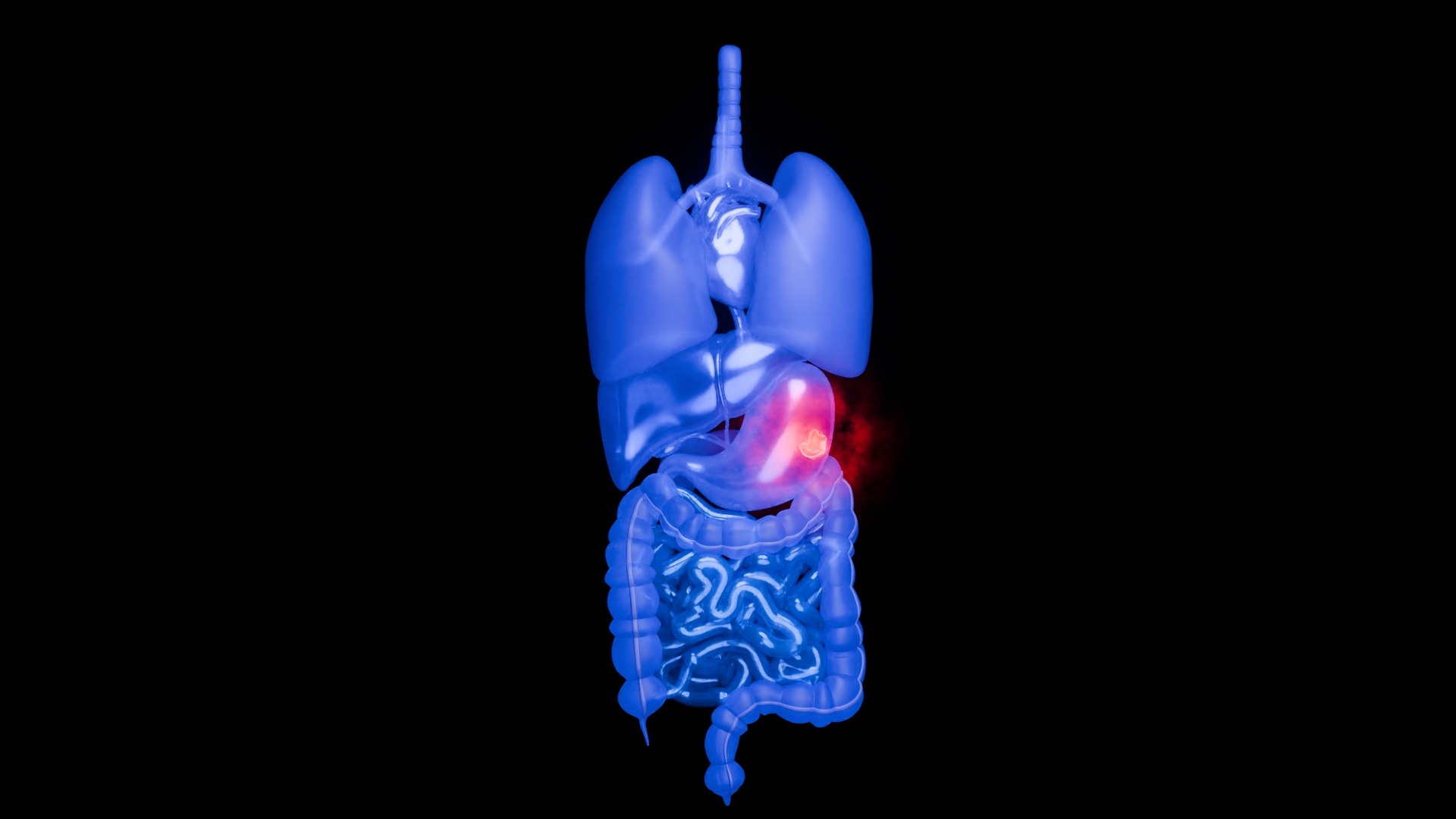 3D Organ with Cancer https://p.turbosquid.com/ts-thumb/Nv/xzPm2l/gv/002/jpg/1773569663/1920x1080/fit_q87/a645d47241dc0d1e58a419dc95e315e3f4f41b5e/002.jpg