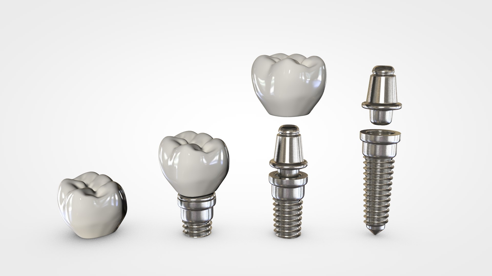 Dental implant 3D model TurboSquid 1679544