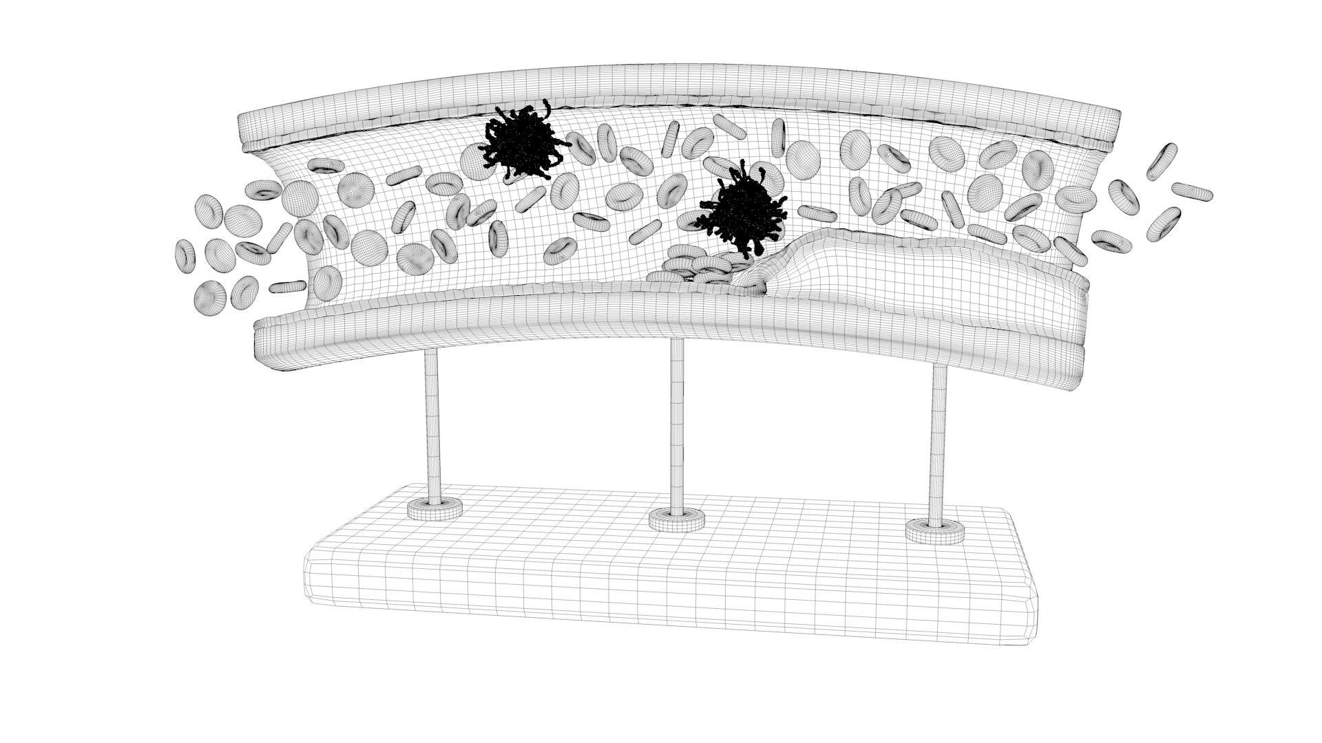 3D sclerotic plaque vessel model https://p.turbosquid.com/ts-thumb/OB/hTv0gm/FJ2Vwokb/sclervessturn02/jpg/1507157138/1920x1080/turn_fit_q99/118306b4a673d95a9a25ae2df4fa9659666e535d/sclervessturn02-1.jpg