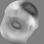 Vessel with Sclerotic Plaque