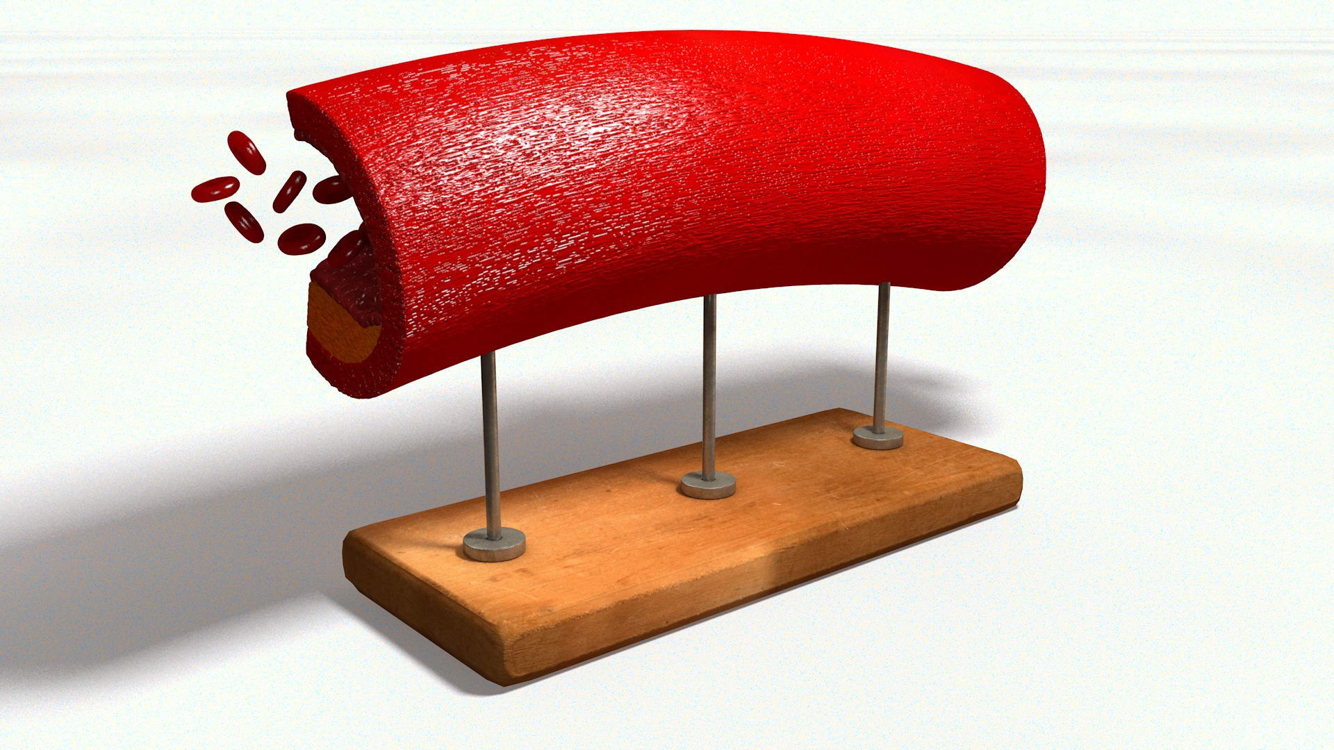 3D sclerotic plaque vessel model https://p.turbosquid.com/ts-thumb/OB/hTv0gm/g7E7bnrP/sclervesselturn010042/jpg/1507156942/1920x1080/fit_q87/1773f6aef642b655849781334a11c59129e147b1/sclervesselturn010042.jpg