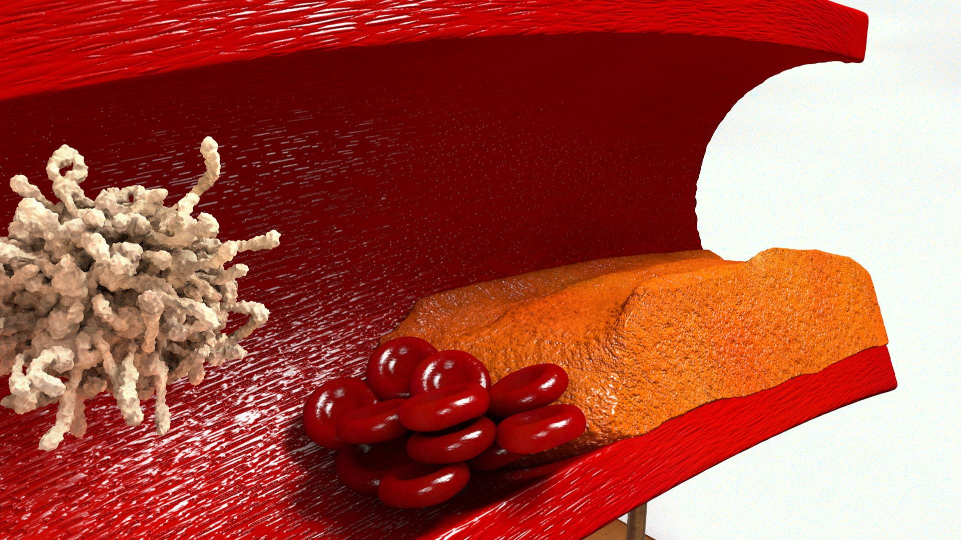 3D sclerotic plaque vessel model https://p.turbosquid.com/ts-thumb/OB/hTv0gm/q5DdP1uC/sclervessel004/jpg/1507156942/1920x1080/fit_q87/035d82eb8a7f39789ceac1810750f75dd044cf5f/sclervessel004.jpg