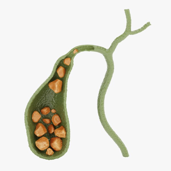 Gallbladder with Gallstones model TurboSquid 1756732