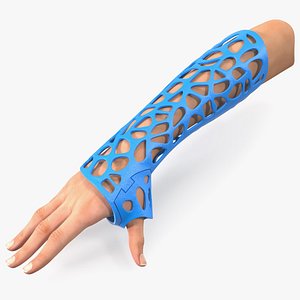3D 3D-Printed Orthopedic Cast On Hand