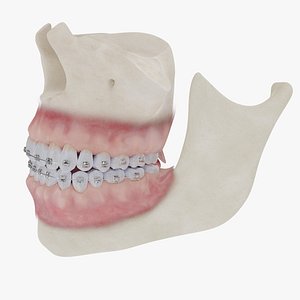 realistic bones gums braces 3D model