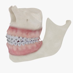 Teeth Gums and Bones with Braces