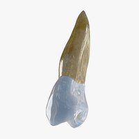 Upper Second Left Bicuspid