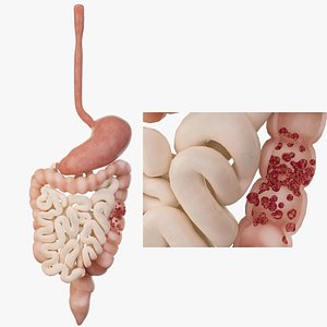 Intestinal polyps  colorectal tumors  Human organ 3D model