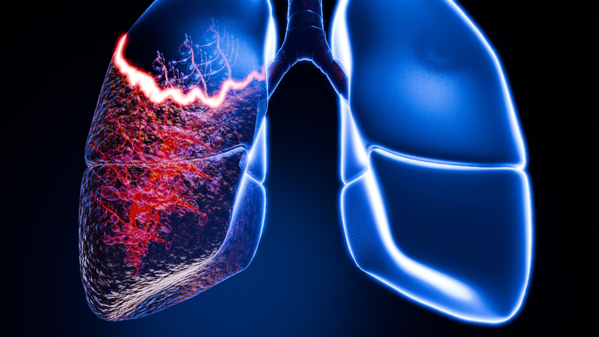 Lung Damage and Lung Cancer Progression Animation 3D model https://p.turbosquid.com/ts-thumb/PC/FKh3M5/dN/0051/jpg/1773581282/1920x1080/fit_q87/91943575907ebd23099e69caad4eac304043306d/0051.jpg