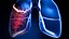 Lung Damage and Lung Cancer Progression Animation