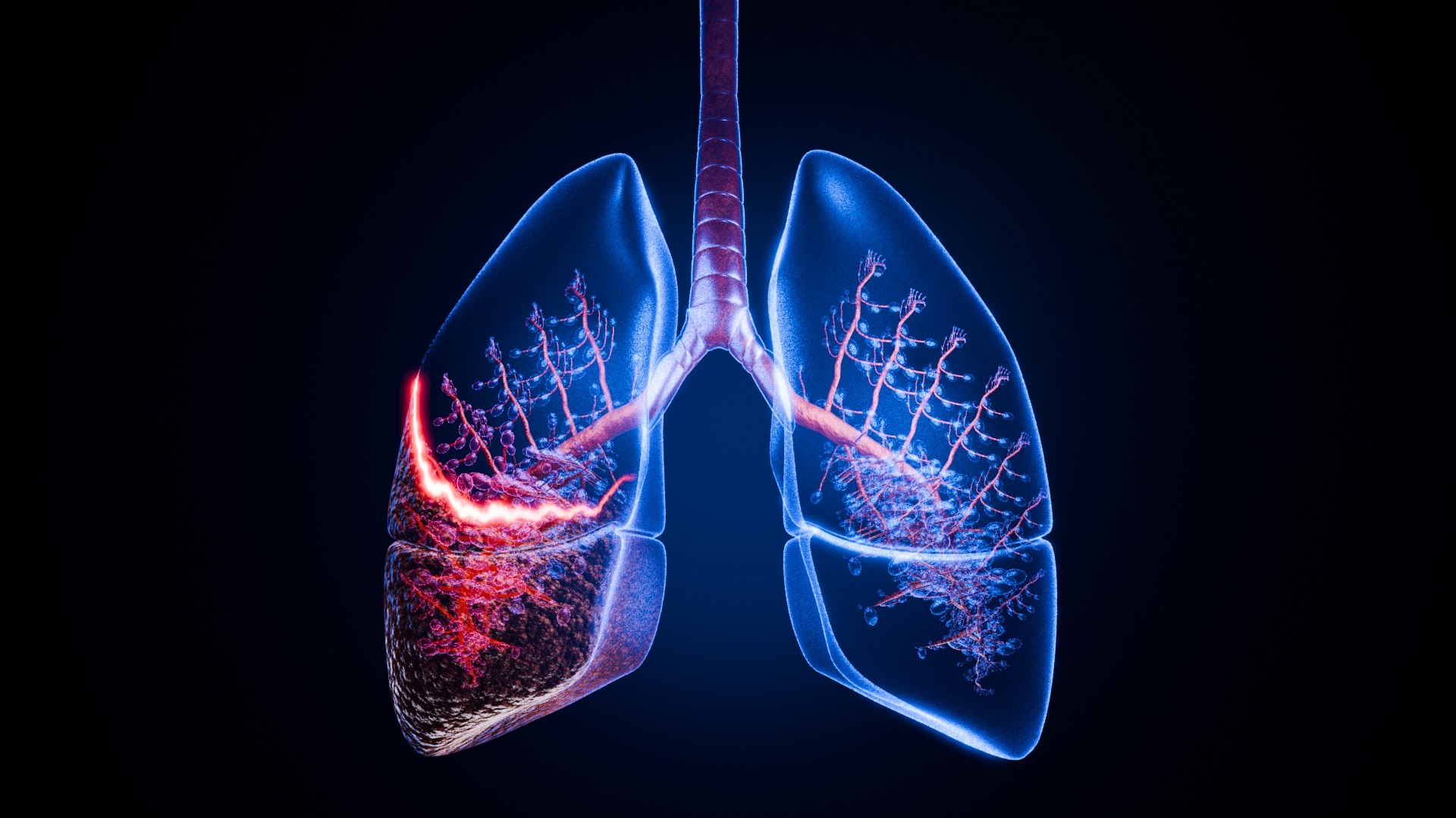 Lung Damage and Lung Cancer Progression Animation 3D model https://p.turbosquid.com/ts-thumb/PC/FKh3M5/l5/002/jpg/1773581279/1920x1080/fit_q87/e3e9d7269b046f2fcc1bd093e3a1b29cd5b8c0f7/002.jpg