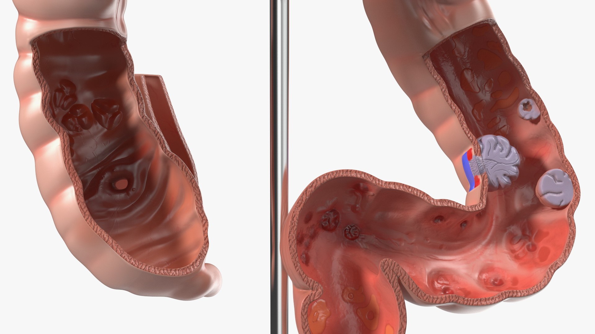 Medical Model Diseased Intestine Model - TurboSquid 2068464