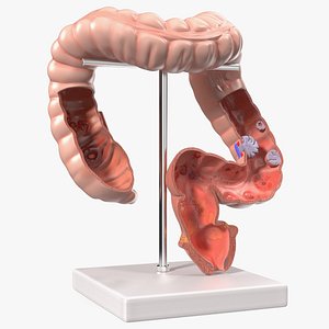 Medical Model Diseased Intestine