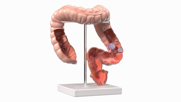 modèle 3D de Modèle médical Intestin malade - TurboSquid 2068464