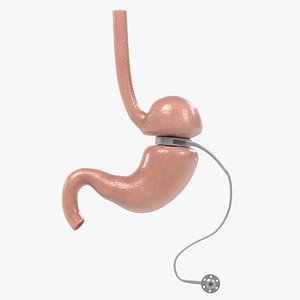 Stomach and Gastric Band