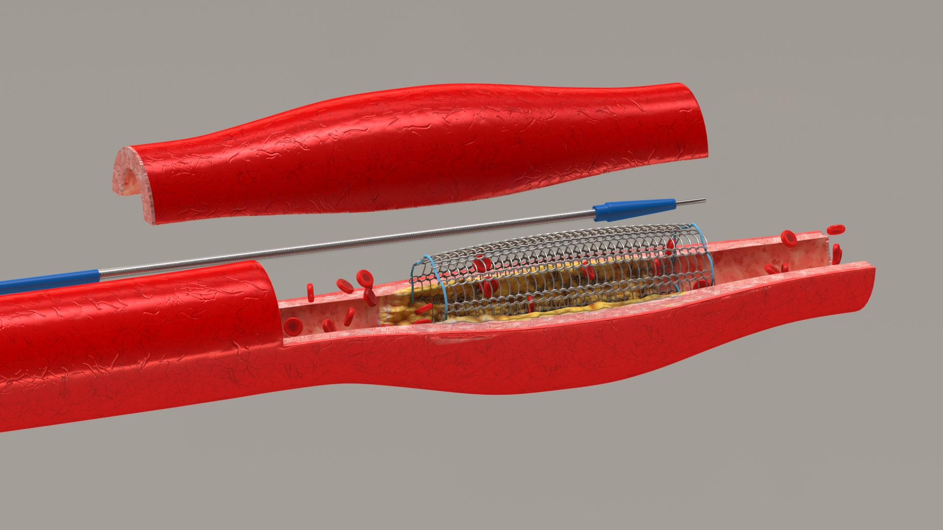 3D stents artery https://p.turbosquid.com/ts-thumb/Pi/6DXgFO/2YSyTSSD/ttable/jpg/1605039340/1920x1080/turn_fit_q99/899d376f15c938b79988caa54745feada383a847/ttable-1.jpg