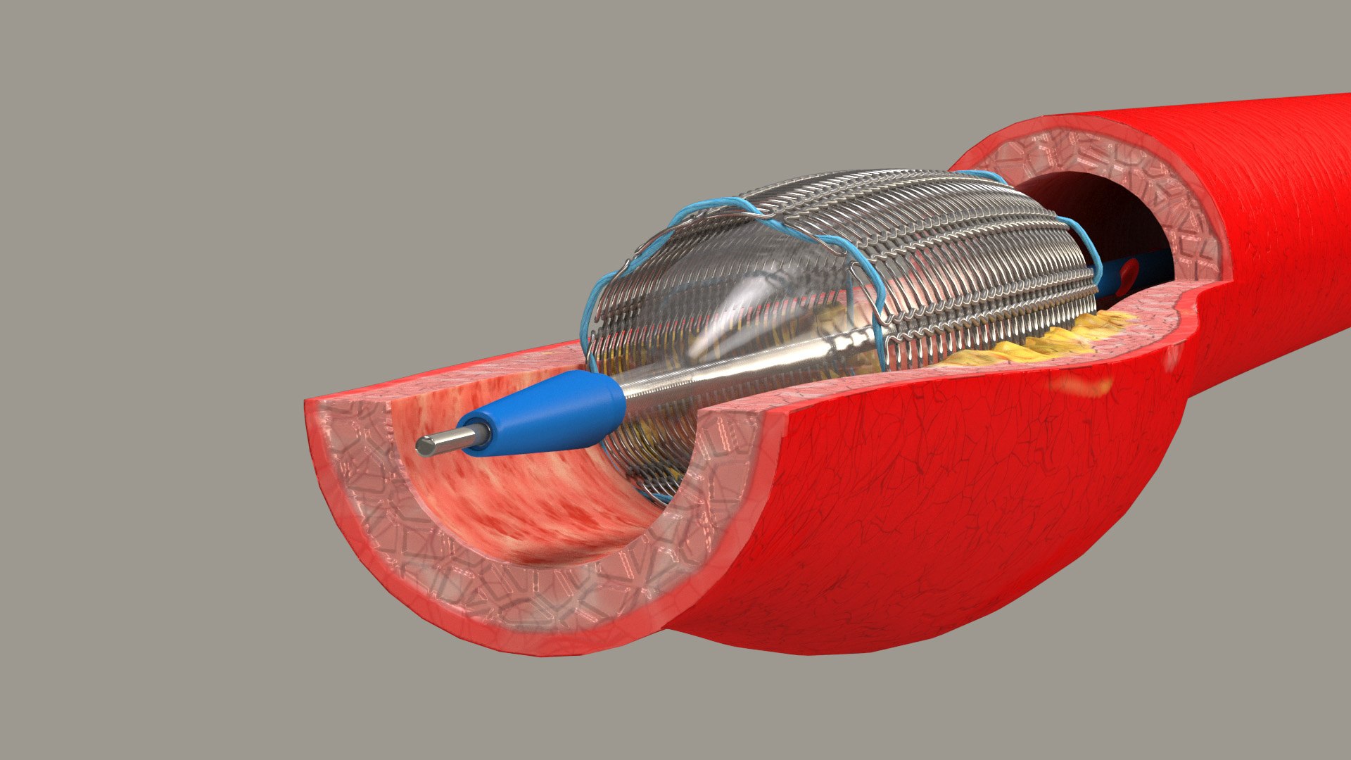 3D stents artery https://p.turbosquid.com/ts-thumb/Pi/6DXgFO/ASrwC1ee/stentwithartery2/jpg/1605039768/1920x1080/fit_q87/2dbe0f8cf57e24978951c93c85e159518c4149ed/stentwithartery2.jpg