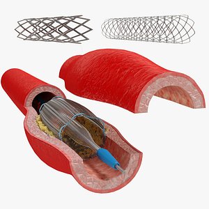 Stents with Artery