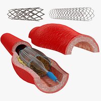 Stents with Artery