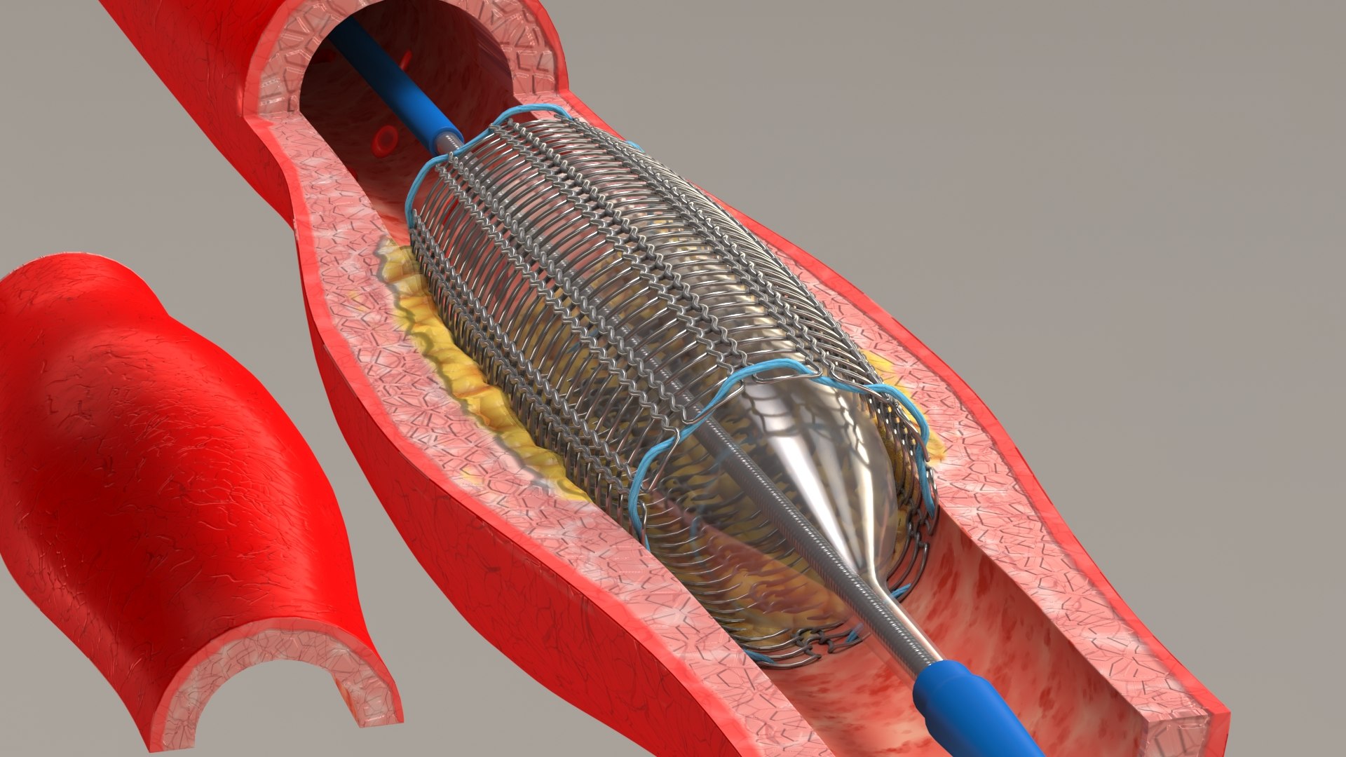3D stents artery https://p.turbosquid.com/ts-thumb/Pi/6DXgFO/TFN0B2gO/stentwithartery5/jpg/1605039768/1920x1080/fit_q87/44973b5cd4147b7400454c67684a509982bf8018/stentwithartery5.jpg