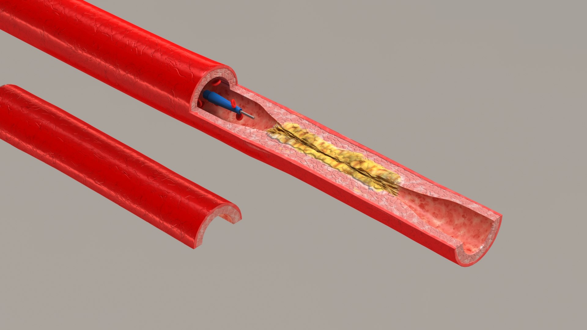 3D stents artery https://p.turbosquid.com/ts-thumb/Pi/6DXgFO/ei4AKokY/stentwithartery3/jpg/1605039768/1920x1080/fit_q87/1e9108f08f5b5806034495c51ddbce7db97c9539/stentwithartery3.jpg