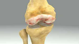 damaged knee joint obj