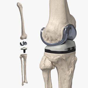 Knee Joint Implant with Femur Tibia and Fibula