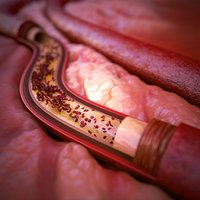 Medical Artery Blood Clot