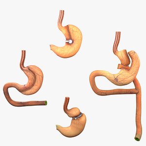 3D Bariatric Surgery Types
