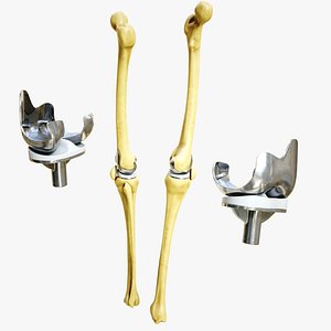 Knee Endoprosthesis