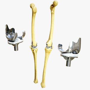 Knee Endoprosthesis