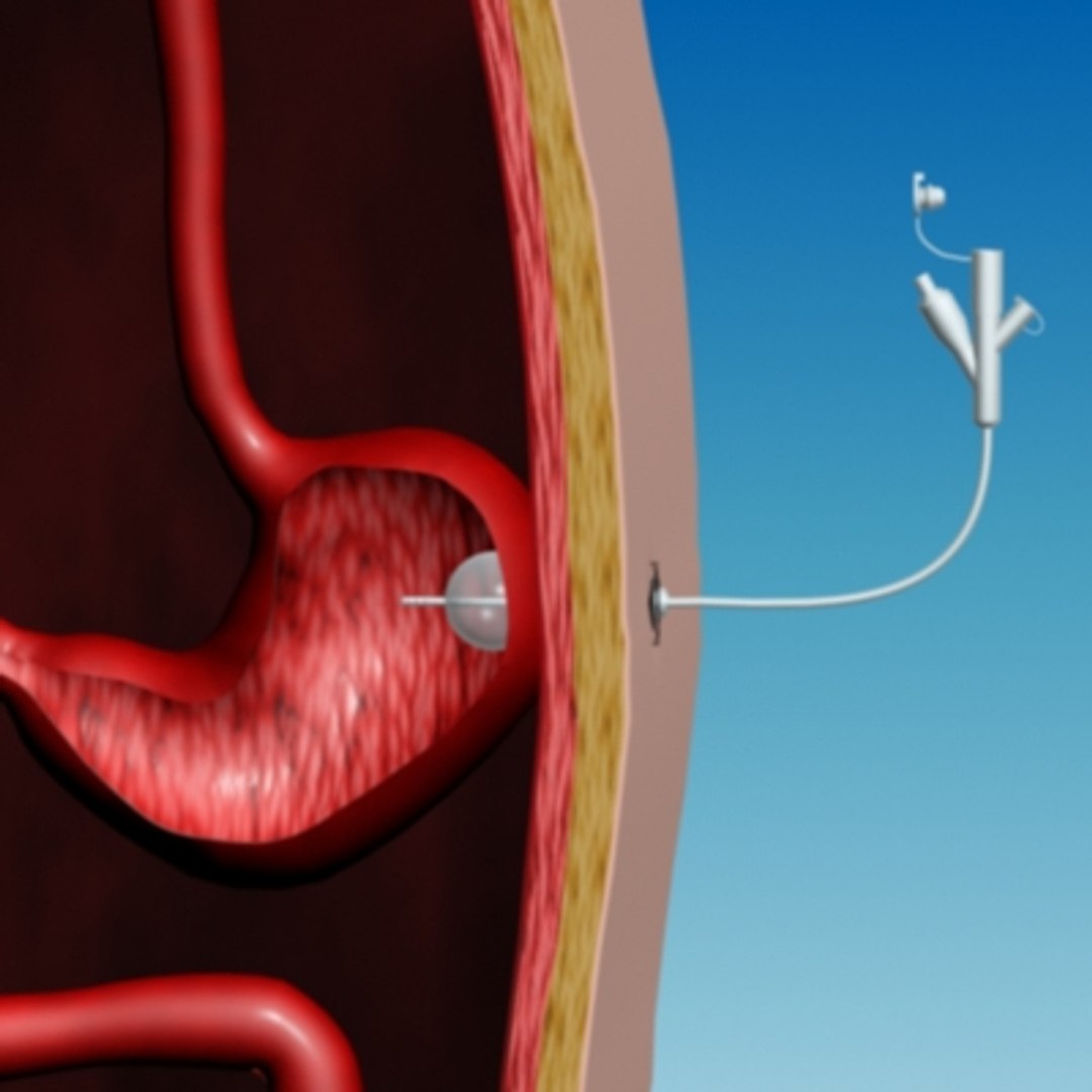 3d-model-of-gastrostomy-stomach