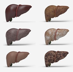 3D Liver Damage Stages