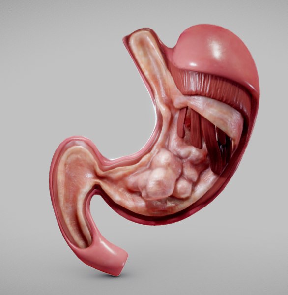 stomach cancer model