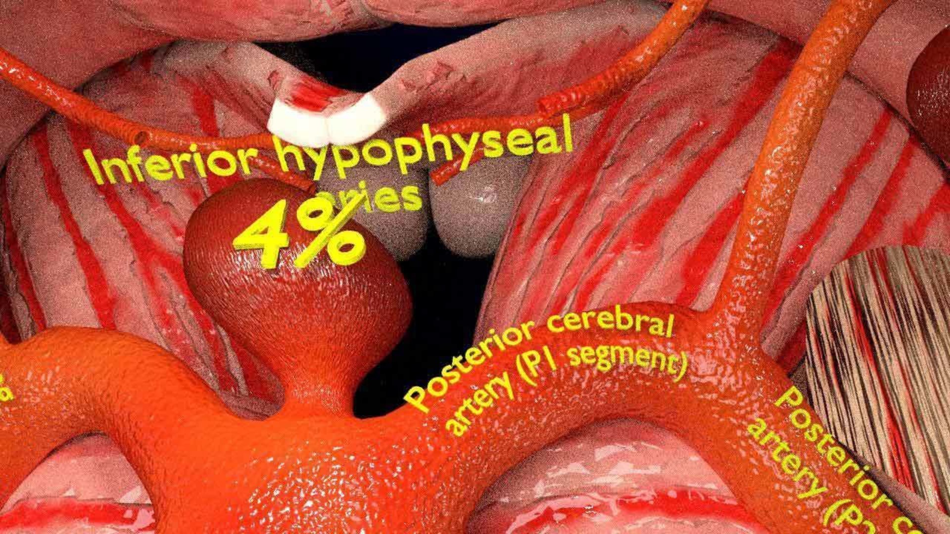 Cerebral aneurysms berry circle of willis 3D model https://p.turbosquid.com/ts-thumb/S0/8AcZxw/4W/5/jpg/1679588175/1920x1080/fit_q87/6484581697731f25421b8cfb4b256eb663cb70f1/5.jpg