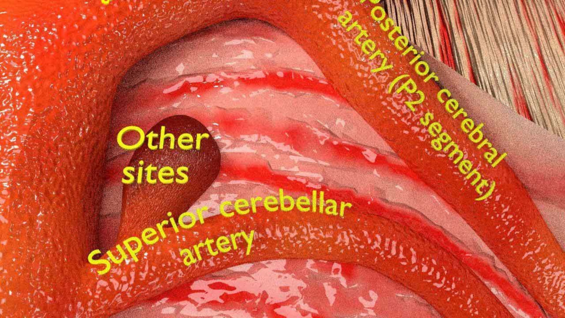 Cerebral aneurysms berry circle of willis 3D model https://p.turbosquid.com/ts-thumb/S0/8AcZxw/LV/4/jpg/1679588173/1920x1080/fit_q87/65dd31931a603054b517ac9fa06b8a7f3cc298ce/4.jpg