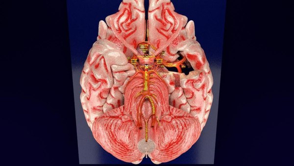 Cerebral aneurysms berry circle of willis 3D model